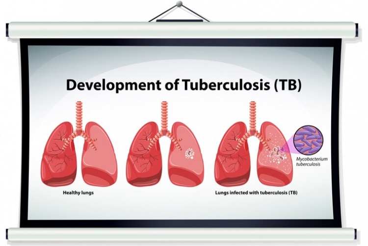 Tuberculosis,